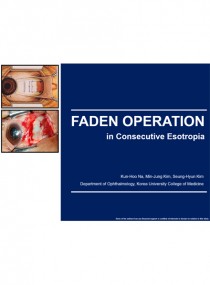 A comparative study on the efficacy of medial rectus recession with Faden operation in consecutive esotropia 표지